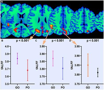 Integrating fractional amplitude of low-frequency fluctuation and functional connectivity to investigate the mechanism and prognosis of severe traumatic brain injury